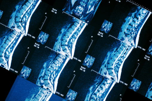 Lesiones de médula espinal