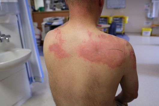 Muchas víctimas de quemaduras no reciben el tratamiento adecuado para sus lesiones