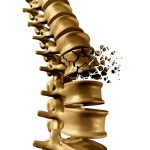 La mayoría de causas comunes de lesiones de médula espinal puede que le sorprendan