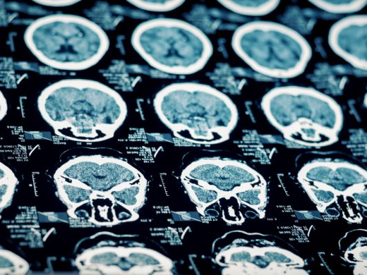 No todas las lesiones cerebrales traumáticas son idénticas: Conozca las principales diferencias