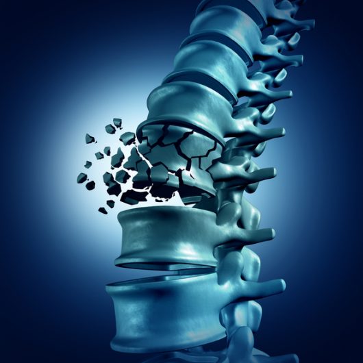 Sus opciones después de una lesión de la médula espinal: ¿Debería trabajar con la compañía de seguros?