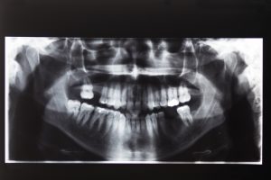 No lidie con el costo de las lesiones dentales después de un accidente de moto por su cuenta: hable con un abogado