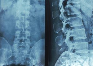 Las lesiones de médula espinal pueden ser causadas por varios factores