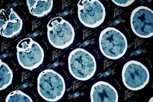 Un nuevo fármaco podría ser un factor de cambio en el tratamiento de las lesiones cerebrales