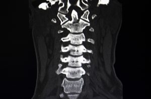 Qué son las lesiones de la médula espinal lumbar y cómo pueden afectar su vida