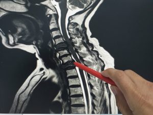 Resultados Comunes de las Lesiones Cerebrales Traumáticas y las Lesiones de la Médula Espinal