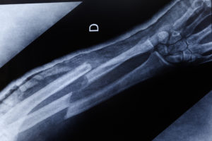 Aprenda sobre las fracturas óseas con un abogado de accidentes de coche en Rancho Cucamonga CA