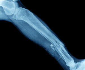 Un abogado de lesiones personales puede ayudarle si ha sufrido una lesión con fractura ósea