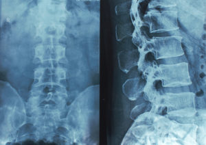 Muchos conductores del Sur de California desconocen cuán comunes son las lesiones de la médula espinal hasta que les suceden